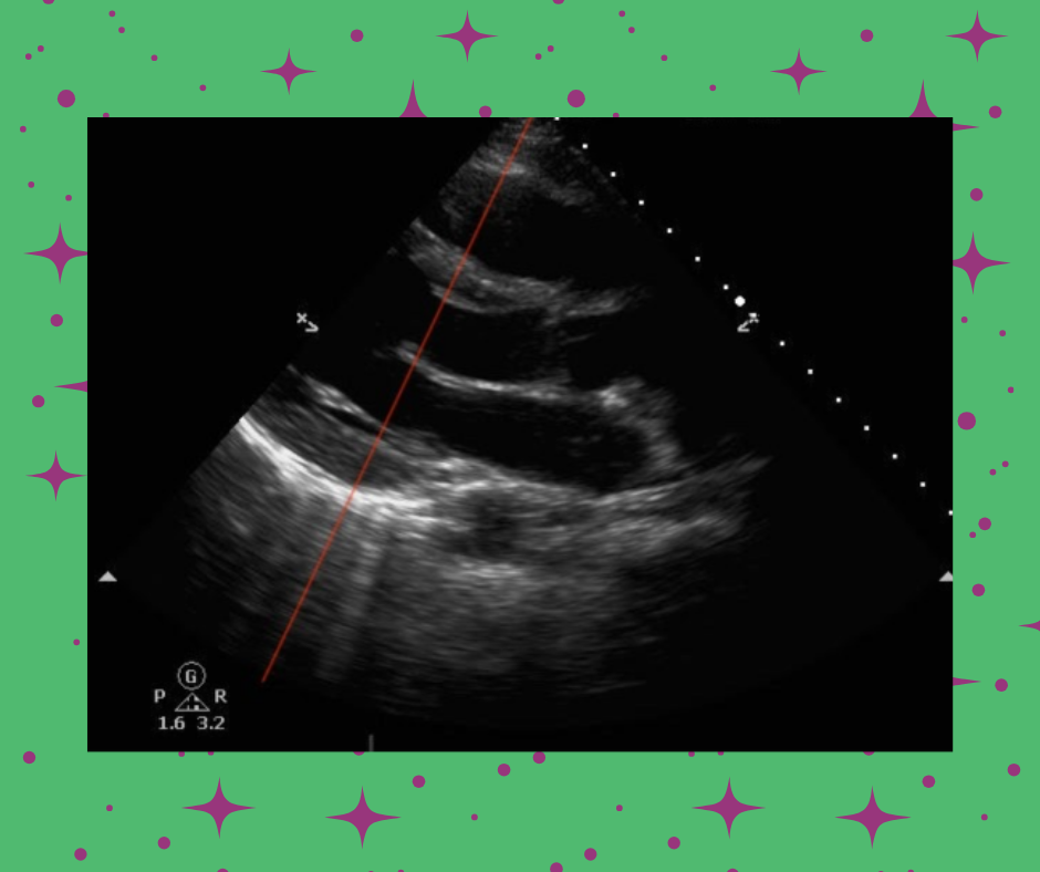 Advanced Critical Care Ultrasound: E-Point Septal Separation to Estimate Left Ventricular Ejection Fraction