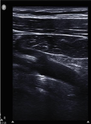 Subclavian Vein Ultrasound