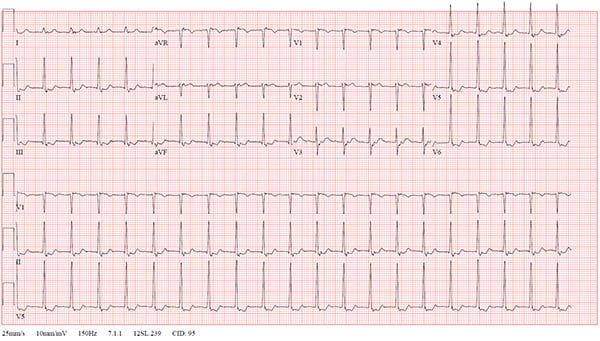 Non Sustained Ventricular Tachycardia Following Modified Valsalva Maneuver For Atrioventricular Nodal Reentry Tachycardia Emra