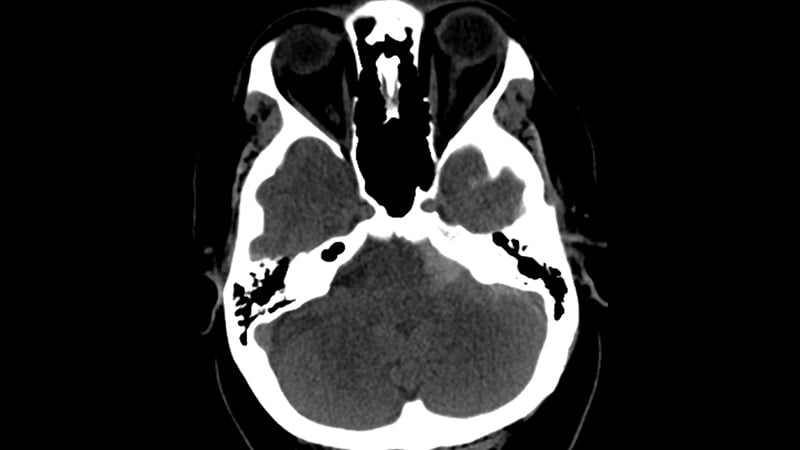 Subarachnoid Hemorrhage Can T Miss Diagnosis And Management Emra