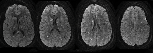 Brain MRI with Axial DWI cuts demonstrating scattered diffusion-restricted lesions predominantly  involving the supratentorial cerebrum.