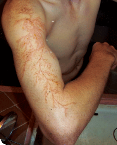 human struck by lightning scars