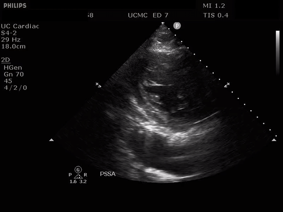 Aortic Dissection 2.gif