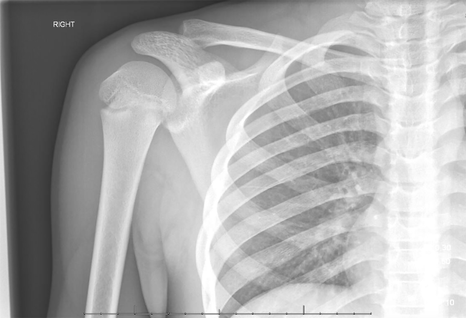 Sternoclavicular Joint Subluxation