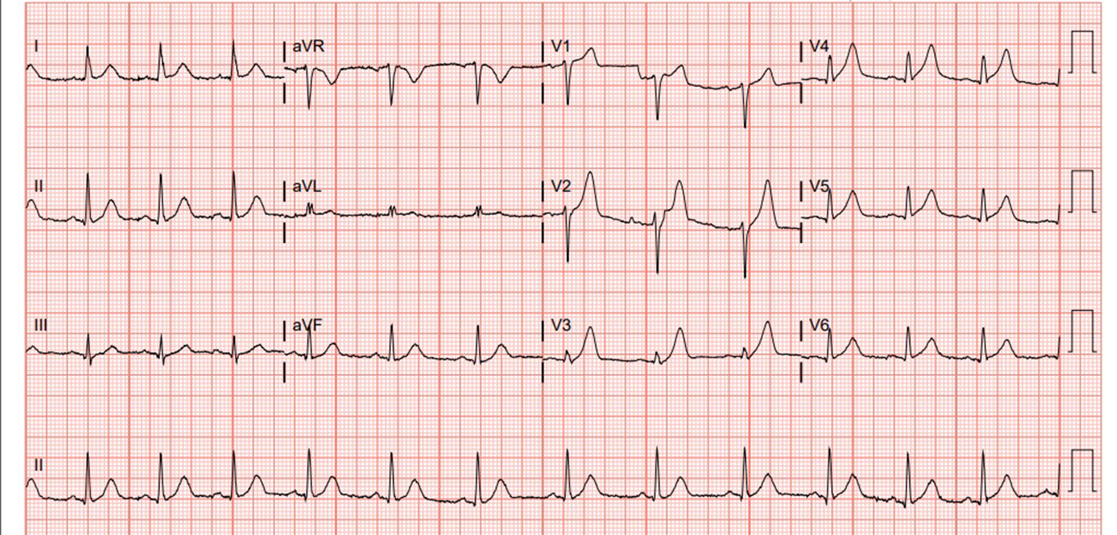 A Case Report Acute Myocardial Infarction In A Year Old Male Emra 62790 ...