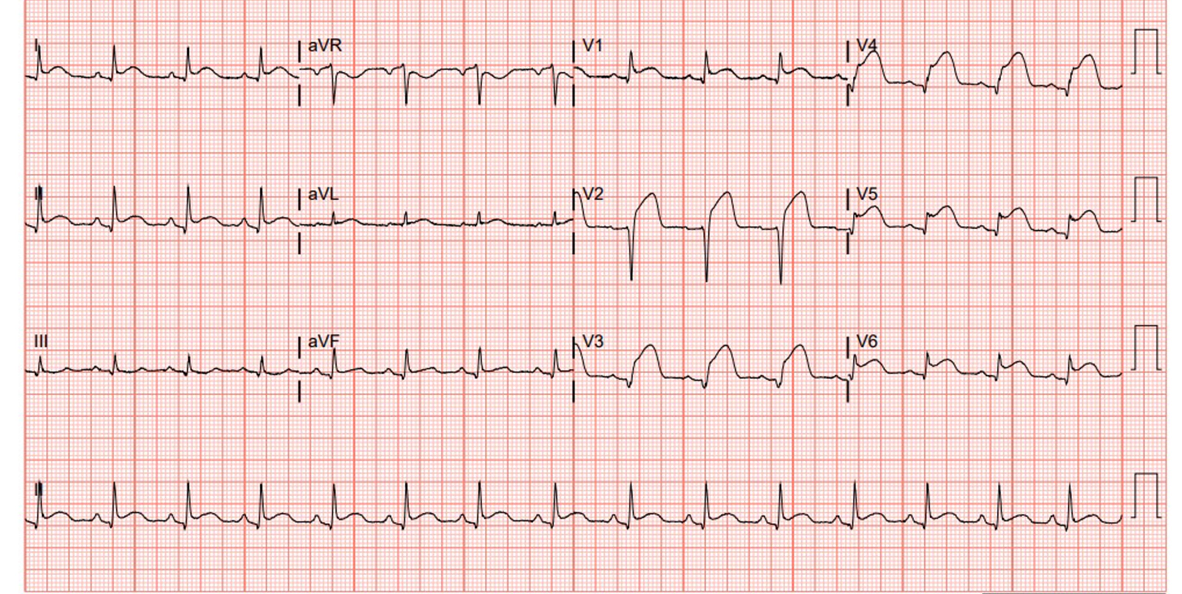 A Case Report Acute Myocardial Infarction In A 29 Year Old Male Emra ...