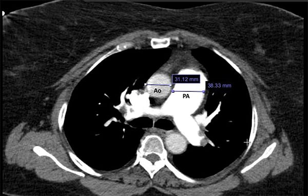 A Case Of Pulmonary Hypertension In The Ed Emra