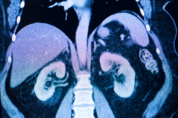 45 5 Contrast Induced Nephropathy 