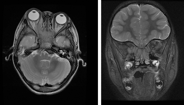 Ocular Instillation of Cyanoacrylate Adhesive: A Case Report EMRA