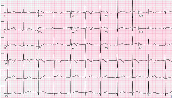 The Pediatric ECG and Long QT Syndrome EMRA