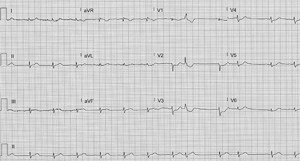 ECG Challenge: February - March 2020 EMRA