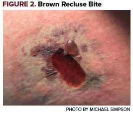 Cureus  Brown Recluse Spider Bite Resulting in Coombs Negative