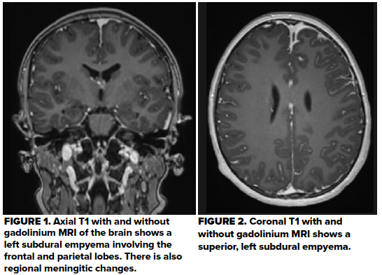 48-1 Pediatric subdural empyema Fig 1-2.png