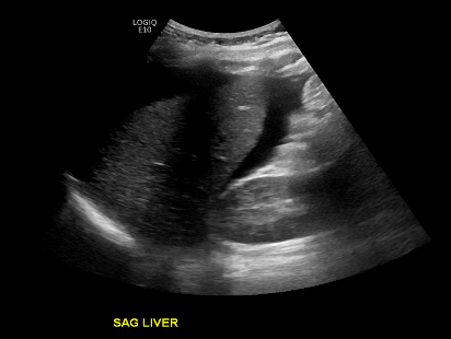 Acute Urinary Retention: A Rare Case of Incarcerated Uterus in the Gravid  ED Patient EMRA