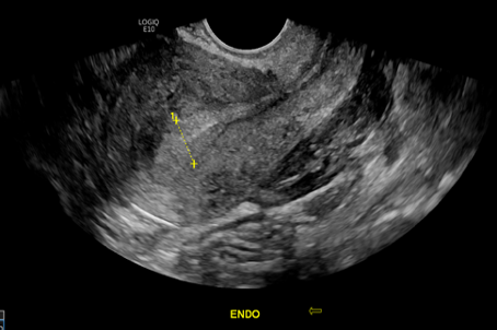 Hemoperitoneum from ruptured heterotopic pregnancy covering