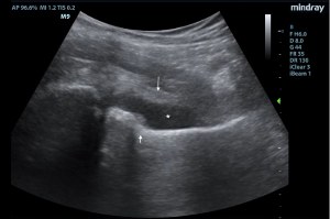 curvilinear probe ultrasound pediatric