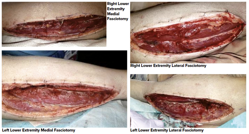 a) A major crush injury of the lower third of the leg, (b) the defect