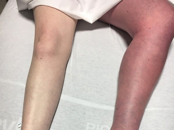My left leg is much larger than the right — and leaks due to rare condition