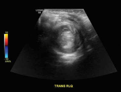 intussusception target sign