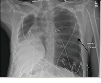 Pneumothorax Image 2.jpg
