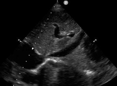 POCUS Figure 11 IVC Ultrasound.png