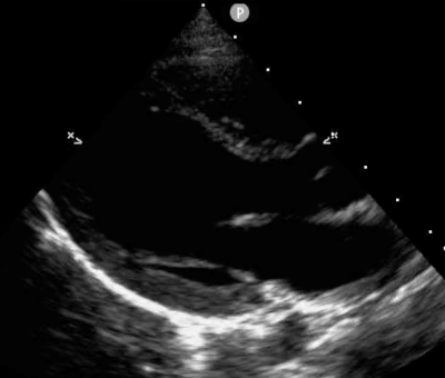 POCUS Figure 5 PSL Ultrasound.png