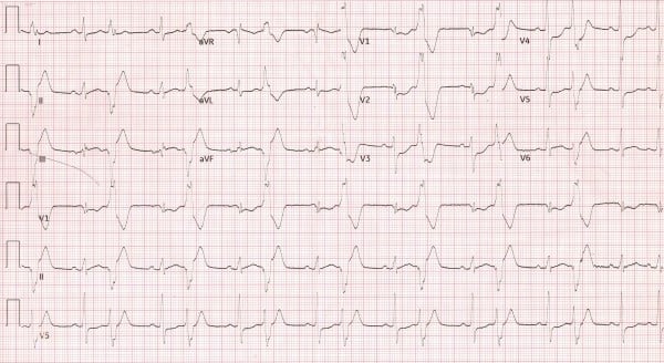 ECG Figure 1 Case EKG.jpeg