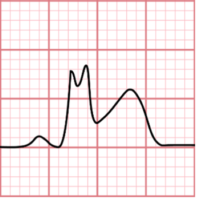 ECG Challenge Figure 1a.png