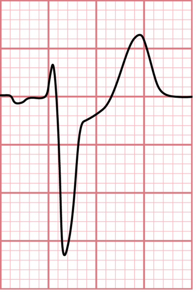 ECG Challenge Figure 1b.png