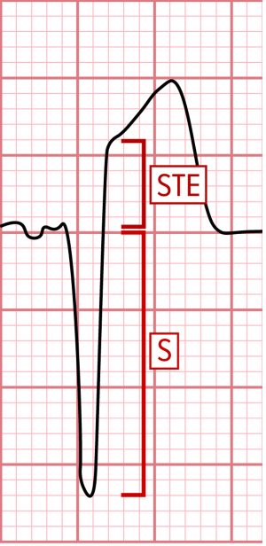 ECG Challenge Figure 1c.png