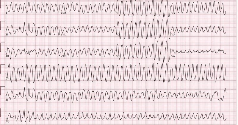 Cardiac Arrest Figure 3.jpg