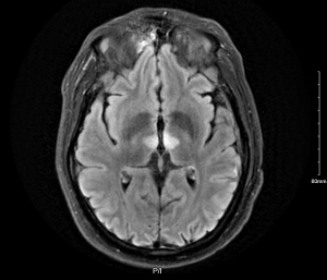 Bilateral Thalamic Infarct: A Diagnosis Not to Sleep On EMRA