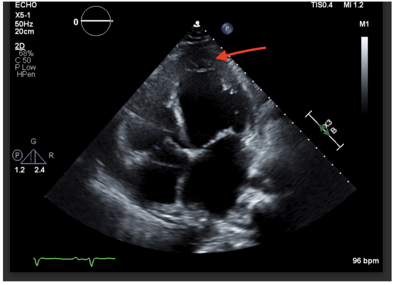 Cardiomyopathy Image 1.png