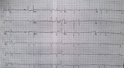 ECG Challenge - Digoxin Toxicity 52-1.jpg