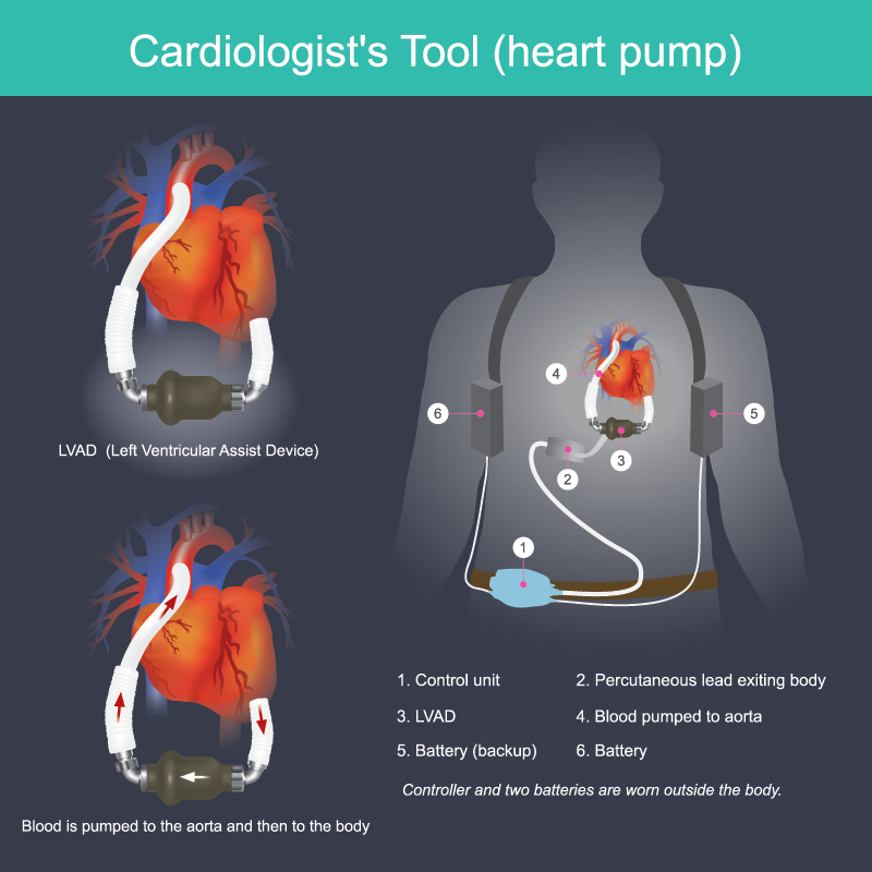 Emergency Department Approach to LVAD Patients EMRA