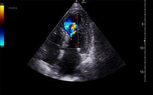 POCUS FTW Septum Image 3 web.jpg