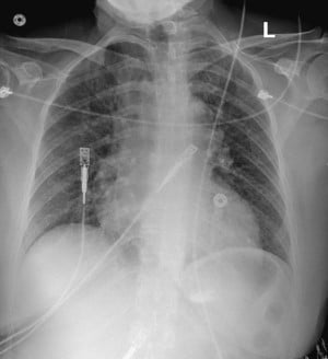 POCUS FTW Septum Image 4.jpeg