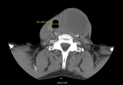 Thyroid Hematoma Image 2 - CT.jpeg