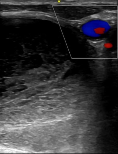 Thyroid Hematoma Image 3 - ultrasound.jpeg