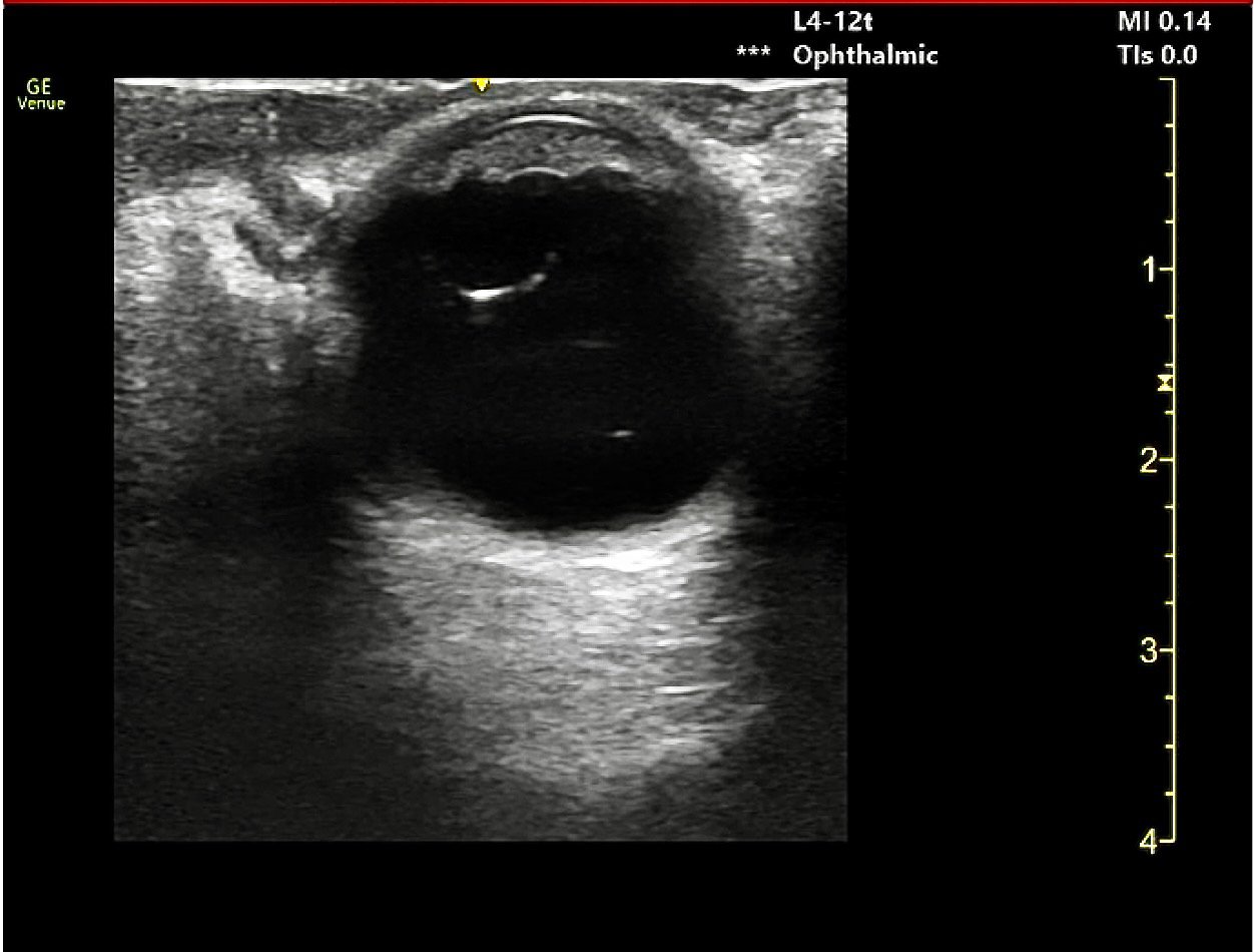 Traumatic Glaucoma Image 1.jpeg