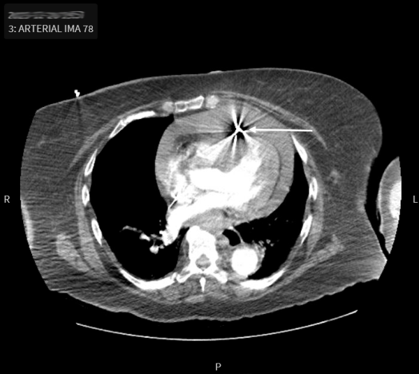 POCUS FTW - Cardiac Tamponade - Fig 1.png