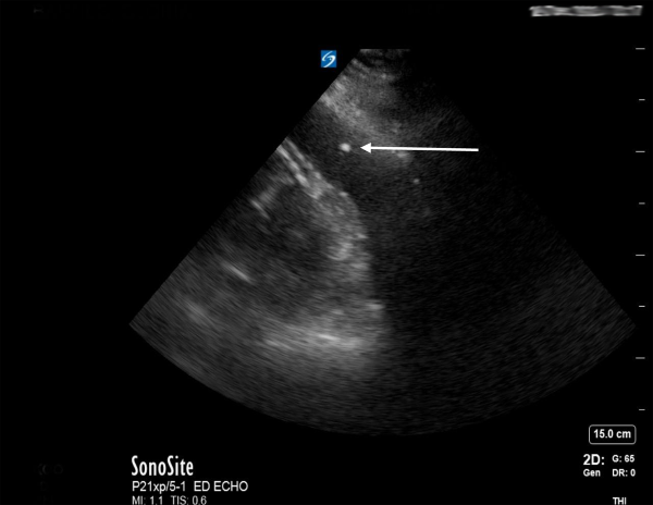 POCUS FTW - Cardiac Tamponade - Fig 2.png