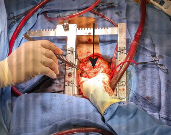 POCUS FTW - Cardiac Tamponade - Fig 3.png