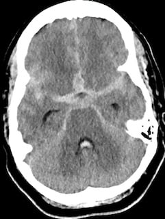 Aneurysmal Image 1.jpg