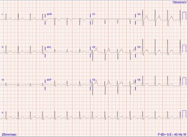 Bezold-Jarisch Reflex - Fig 1.jpg