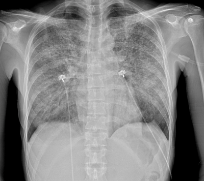 Pneumocystis Pneumonia - CXR.png