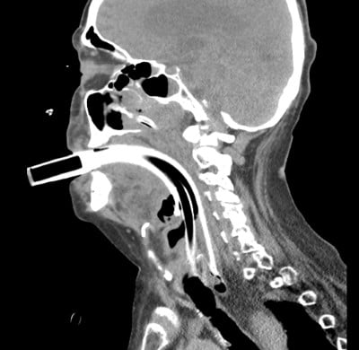 Trismus - Fig 1 CT neck.jpg