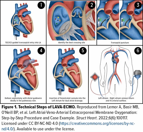 LAVA-ECMO.jpg