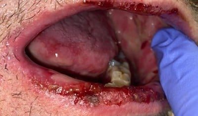 Behcet Figure 2 Oral Lesions.jpeg