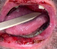 Behcet Figure 3 Oral Lesions.jpeg